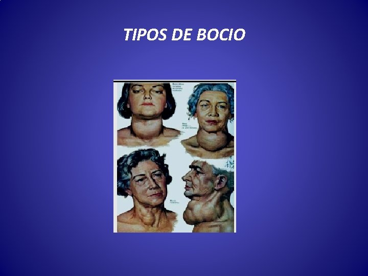 TIPOS DE BOCIO 