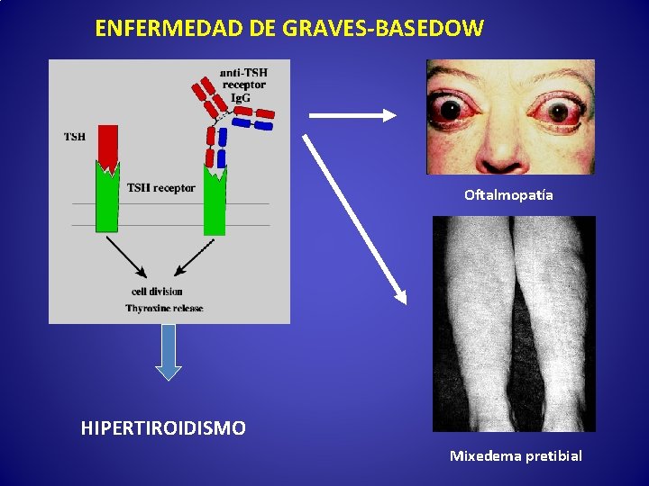 ENFERMEDAD DE GRAVES-BASEDOW Oftalmopatía HIPERTIROIDISMO Mixedema pretibial 