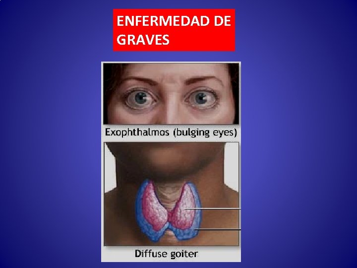 ENFERMEDAD DE GRAVES 