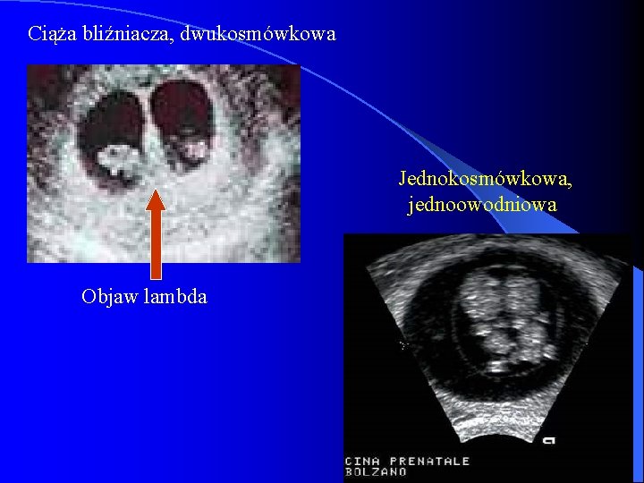 Ciąża bliźniacza, dwukosmówkowa Jednokosmówkowa, jednoowodniowa Objaw lambda 