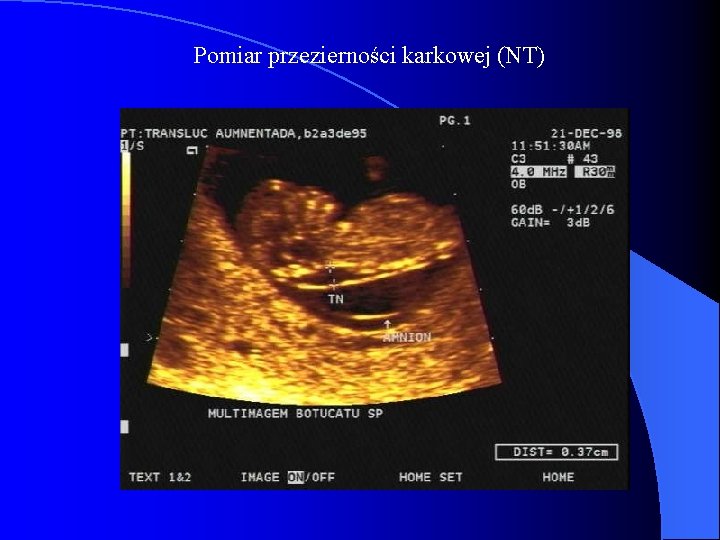 Pomiar przezierności karkowej (NT) 