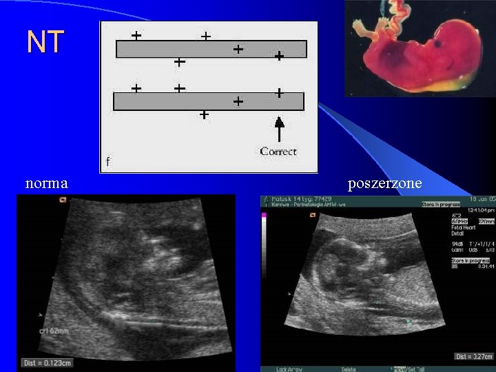 NT norma Poradnia Perinatologii i Kardiologii Perinatalnej poszerzone 