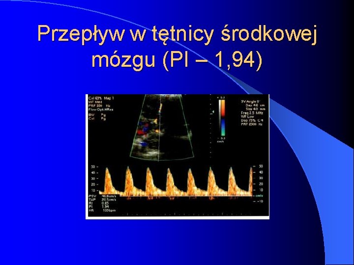 Przepływ w tętnicy środkowej mózgu (PI – 1, 94) 