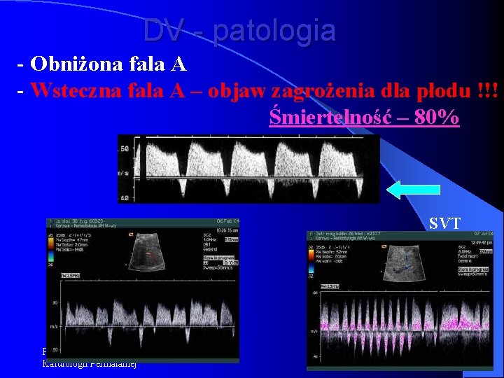 DV - patologia - Obniżona fala A - Wsteczna fala A – objaw zagrożenia