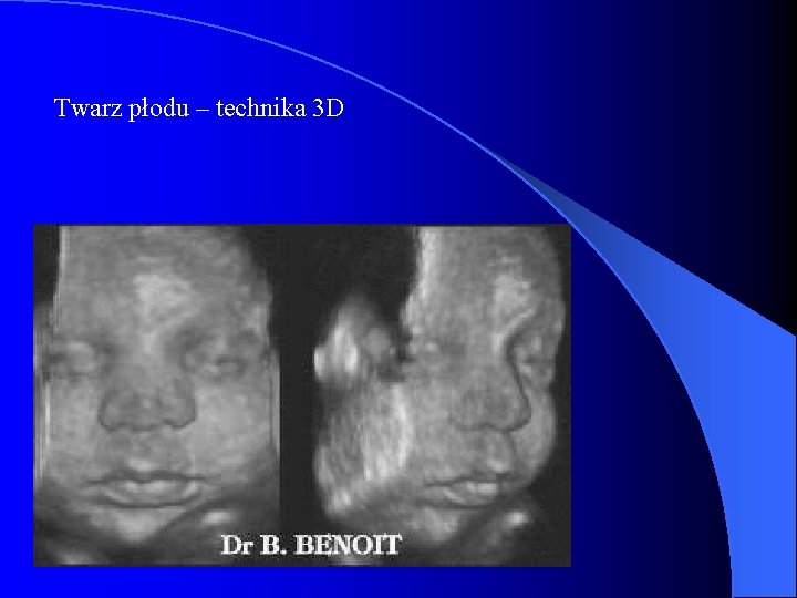 Twarz płodu – technika 3 D 