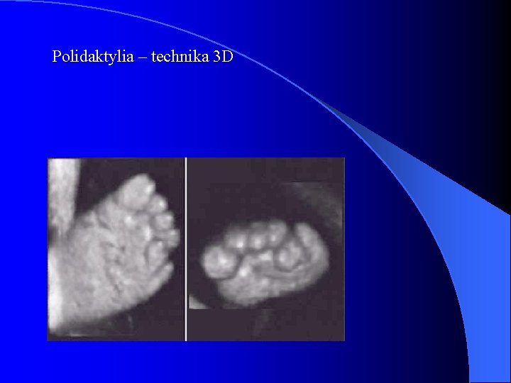 Polidaktylia – technika 3 D 