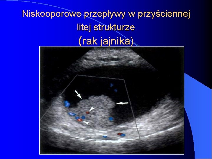 Niskooporowe przepływy w przyściennej litej strukturze (rak jajnika) 