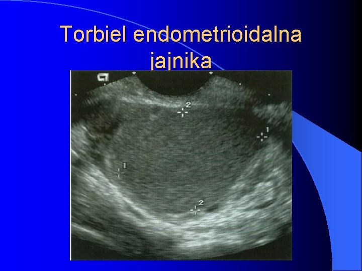 Torbiel endometrioidalna jajnika 