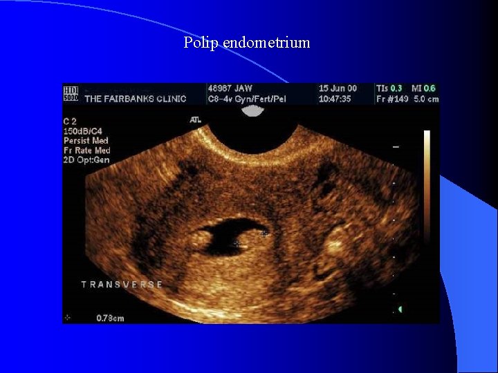 Polip endometrium 