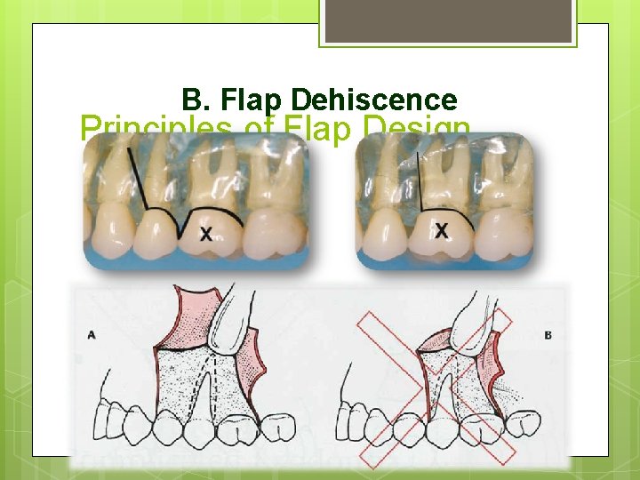 B. Flap Dehiscence Principles of Flap Design 