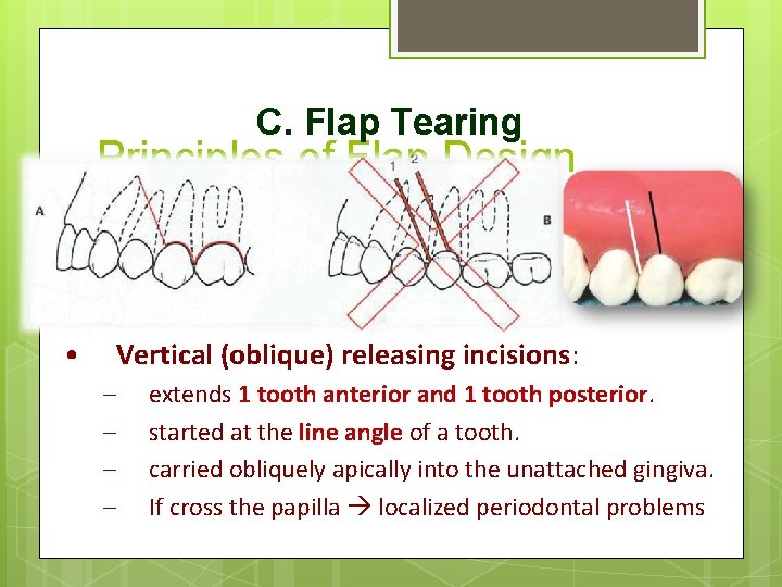 C. Flap Tearing • Principles of Flap Design Envelope flaps – – an incision