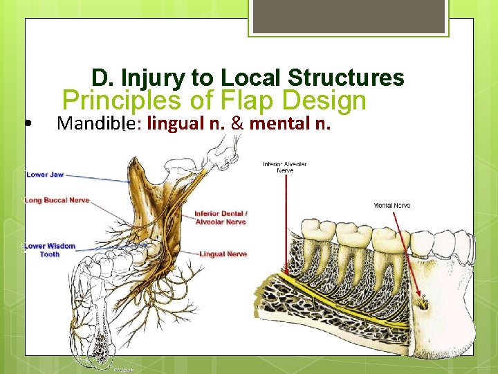 D. Injury to Local Structures • Principles of Flap Design Mandible: lingual n. &