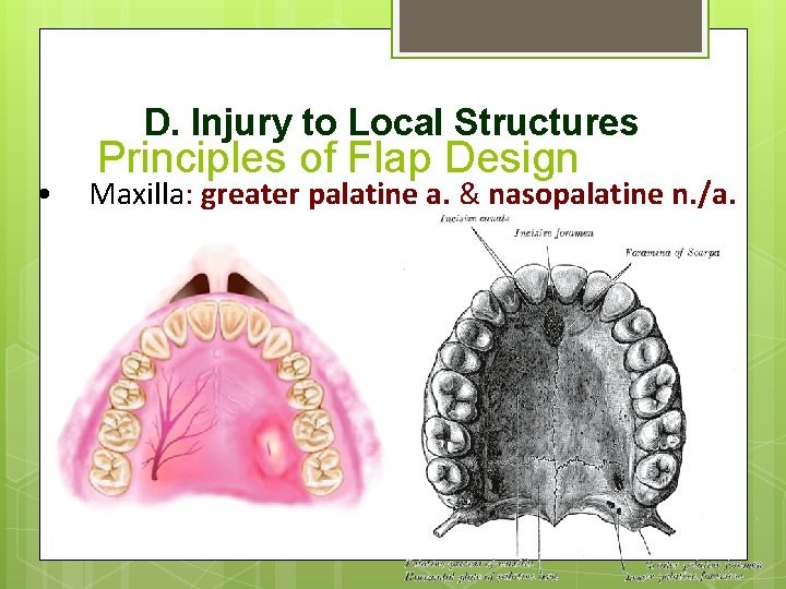 D. Injury to Local Structures • Principles of Flap Design Maxilla: greater palatine a.