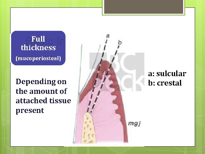 Full Incisions Basic thickness (mucoperiosteal) Depending on the amount of attached tissue present a: