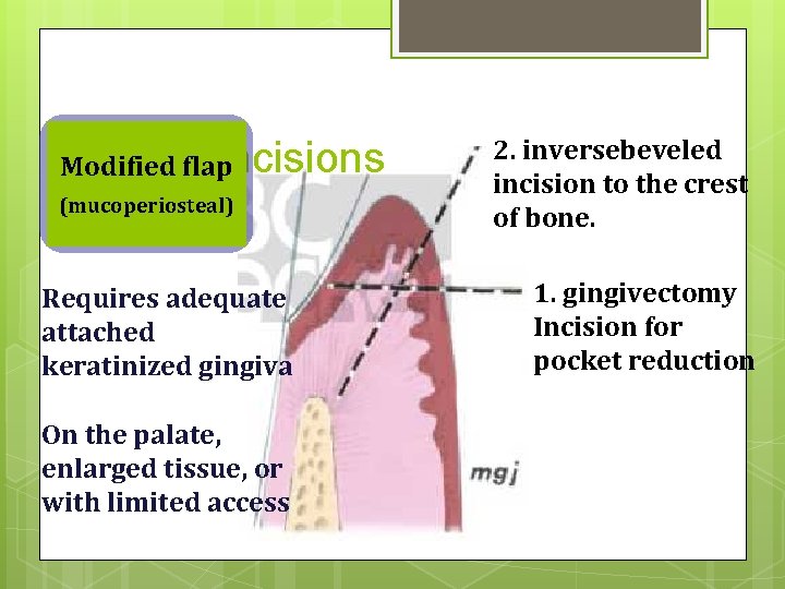 Basicflap. Incisions Modified (mucoperiosteal) Requires adequate attached keratinized gingiva On the palate, enlarged tissue,