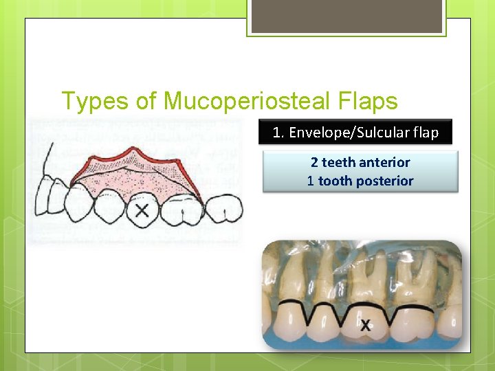 Types of Mucoperiosteal Flaps 1. Envelope/Sulcular flap 2 teeth anterior 1 tooth posterior 