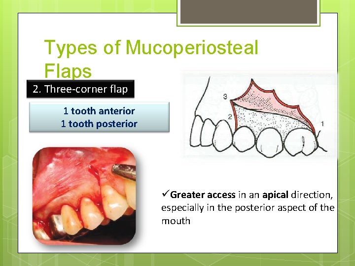Types of Mucoperiosteal Flaps 2. Three-corner flap 1 tooth anterior 1 tooth posterior üGreater