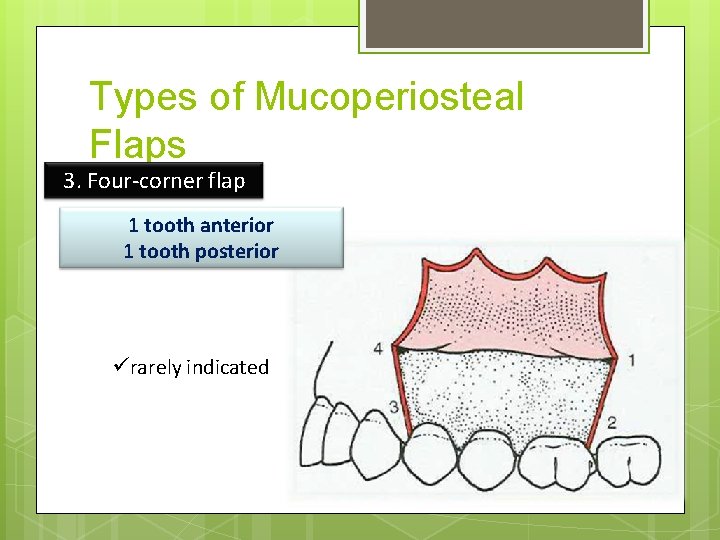 Types of Mucoperiosteal Flaps 3. Four-corner flap 1 tooth anterior 1 tooth posterior ürarely