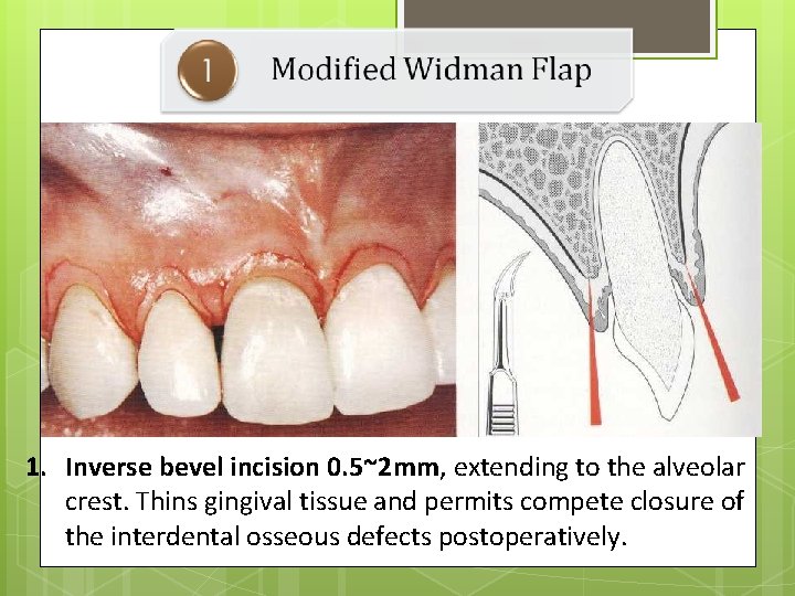 1. Inverse bevel incision 0. 5~2 mm, extending to the alveolar crest. Thins gingival