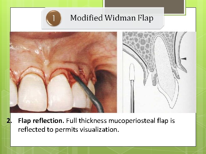 2. Flap reflection. Full thickness mucoperiosteal flap is reflected to permits visualization. 