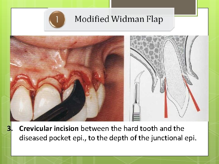 3. Crevicular incision between the hard tooth and the diseased pocket epi. , to
