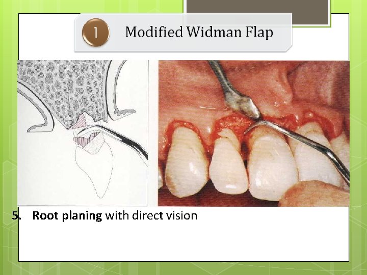 5. Root planing with direct vision 