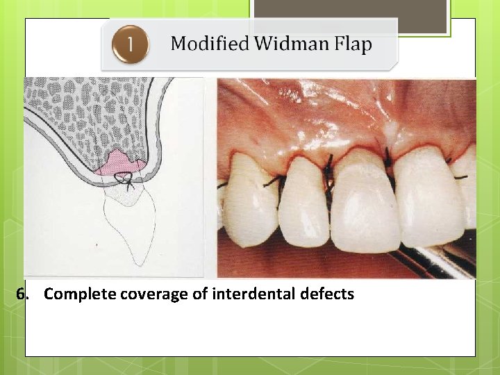 6. Complete coverage of interdental defects 