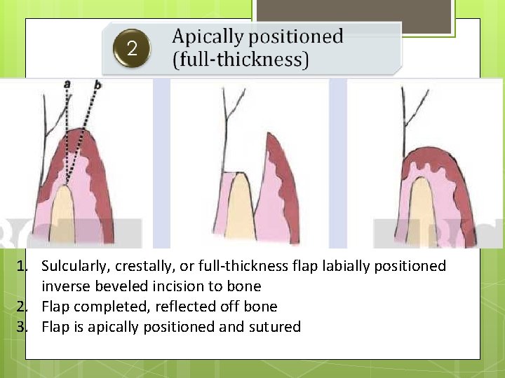 1. Sulcularly, crestally, or full-thickness flap labially positioned inverse beveled incision to bone 2.