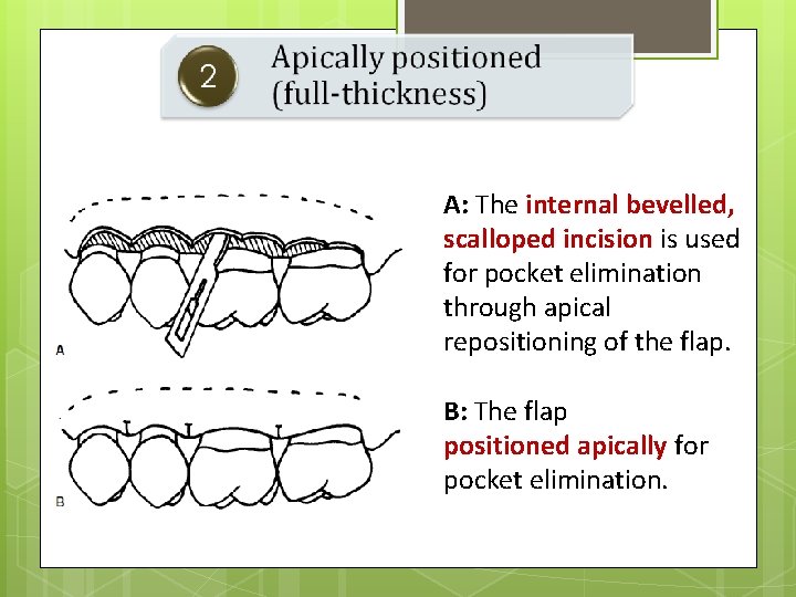 A: The internal bevelled, scalloped incision is used for pocket elimination through apical repositioning