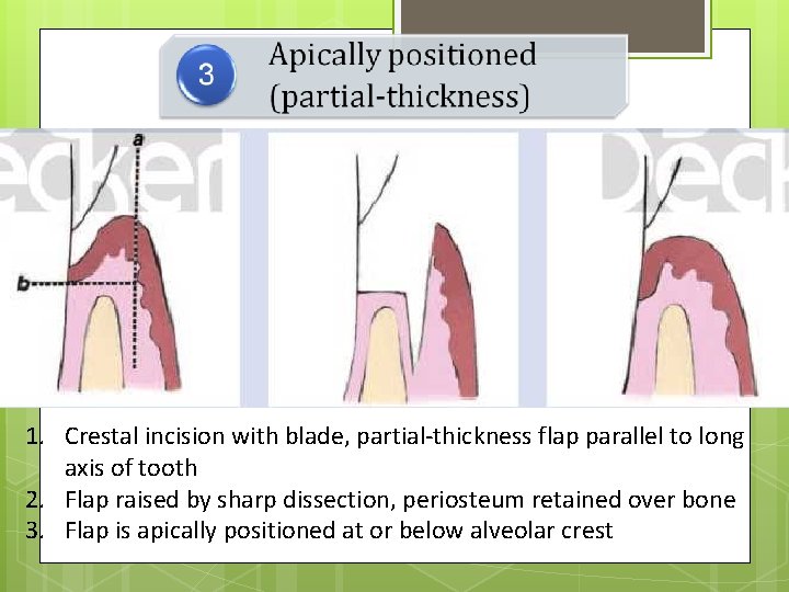 1. Crestal incision with blade, partial-thickness flap parallel to long axis of tooth 2.