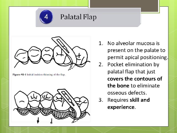 1. No alveolar mucosa is present on the palate to permit apical positioning. 2.