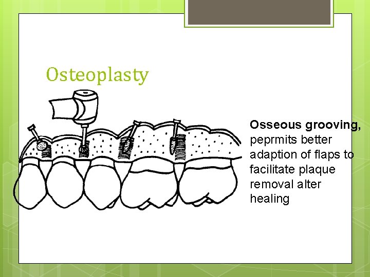 Osteoplasty Osseous grooving, peprmits better adaption of flaps to facilitate plaque removal alter healing