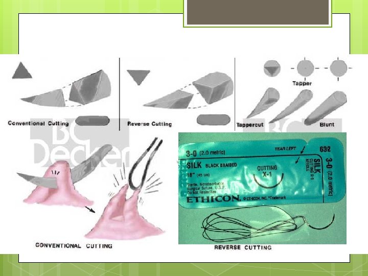 Suturing for Flap Surgery 