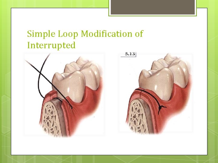 Simple Loop Modification of Interrupted 