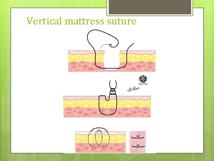 Vertical mattress suture 