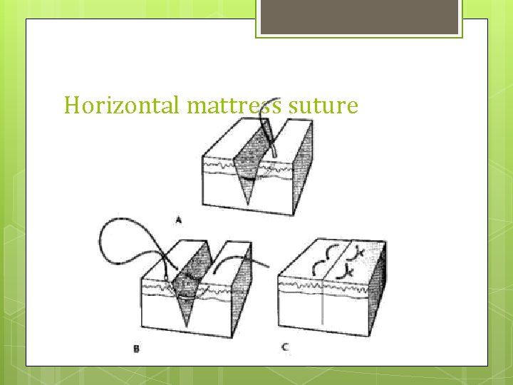 Horizontal mattress suture 