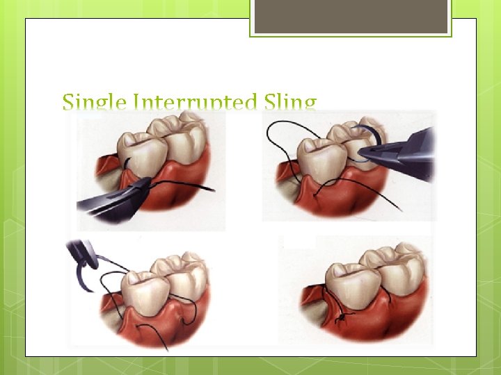 Single Interrupted Sling 