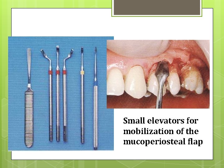 Instruments Small elevators for mobilization of the mucoperiosteal flap 