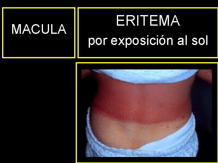 MACULA ERITEMA por exposición al sol Impétigo estreptocócico 
