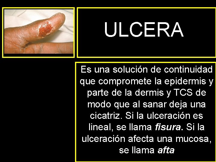 ULCERA Es una solución de continuidad que compromete la epidermis y parte de la