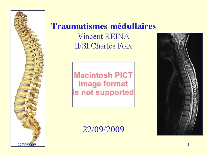 Traumatismes médullaires Vincent REINA IFSI Charles Foix 22/09/2009 1 