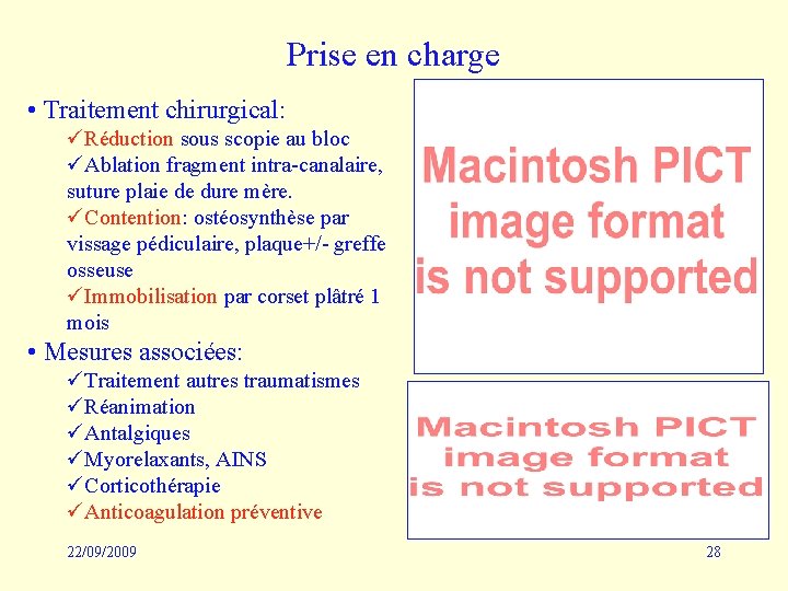 Prise en charge • Traitement chirurgical: üRéduction sous scopie au bloc üAblation fragment intra-canalaire,