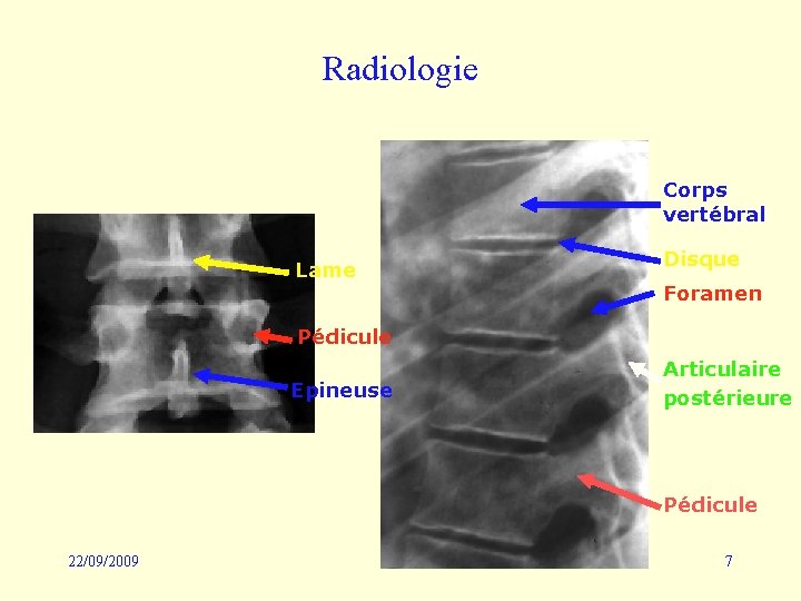 Radiologie Corps vertébral Lame Disque Foramen Pédicule Epineuse Articulaire postérieure Pédicule 22/09/2009 7 