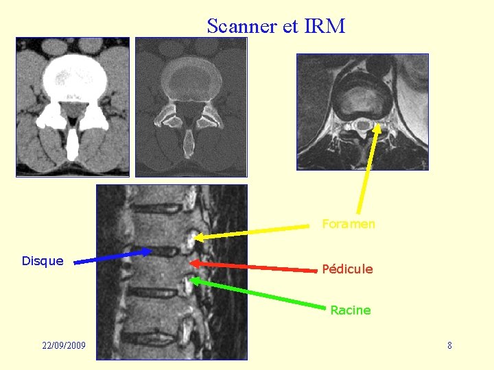 Scanner et IRM Foramen Disque Pédicule Racine 22/09/2009 8 