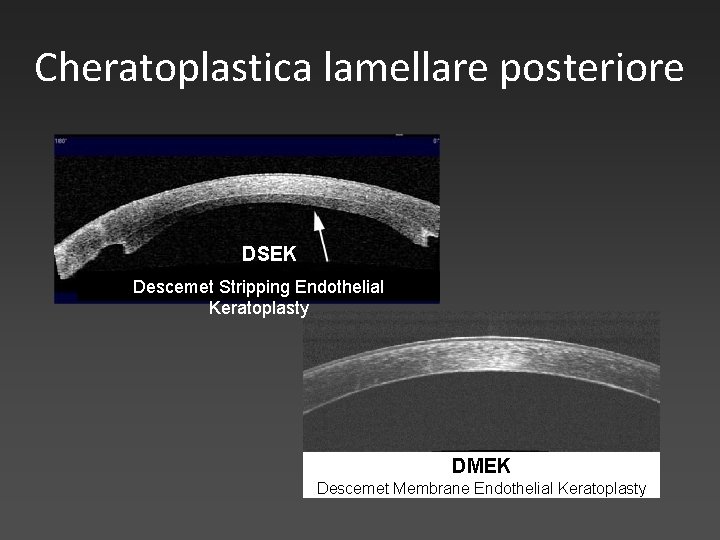 Cheratoplastica lamellare posteriore DSEK Descemet Stripping Endothelial Keratoplasty DMEK Descemet Membrane Endothelial Keratoplasty 