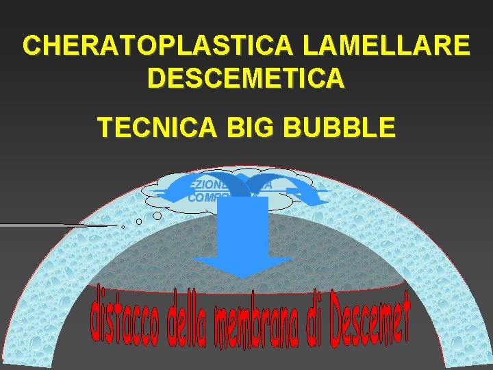 CHERATOPLASTICA LAMELLARE DESCEMETICA TECNICA BIG BUBBLE INIEZIONE DI ARIA COMPRESSA 