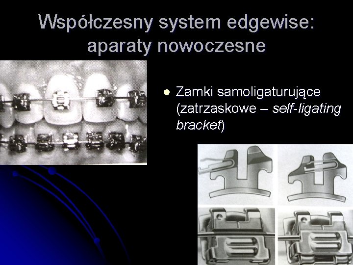 Współczesny system edgewise: aparaty nowoczesne l Zamki samoligaturujące (zatrzaskowe – self-ligating bracket) 