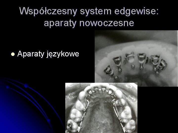 Współczesny system edgewise: aparaty nowoczesne l Aparaty językowe 