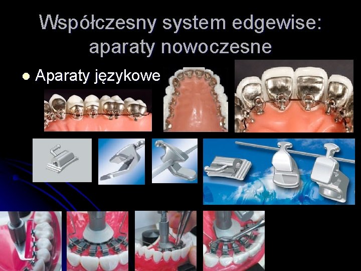 Współczesny system edgewise: aparaty nowoczesne l Aparaty językowe 