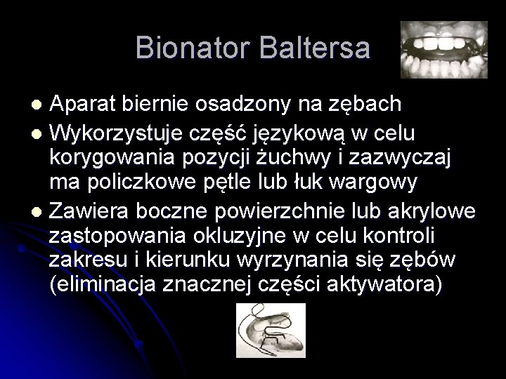 Bionator Baltersa Aparat biernie osadzony na zębach l Wykorzystuje część językową w celu korygowania